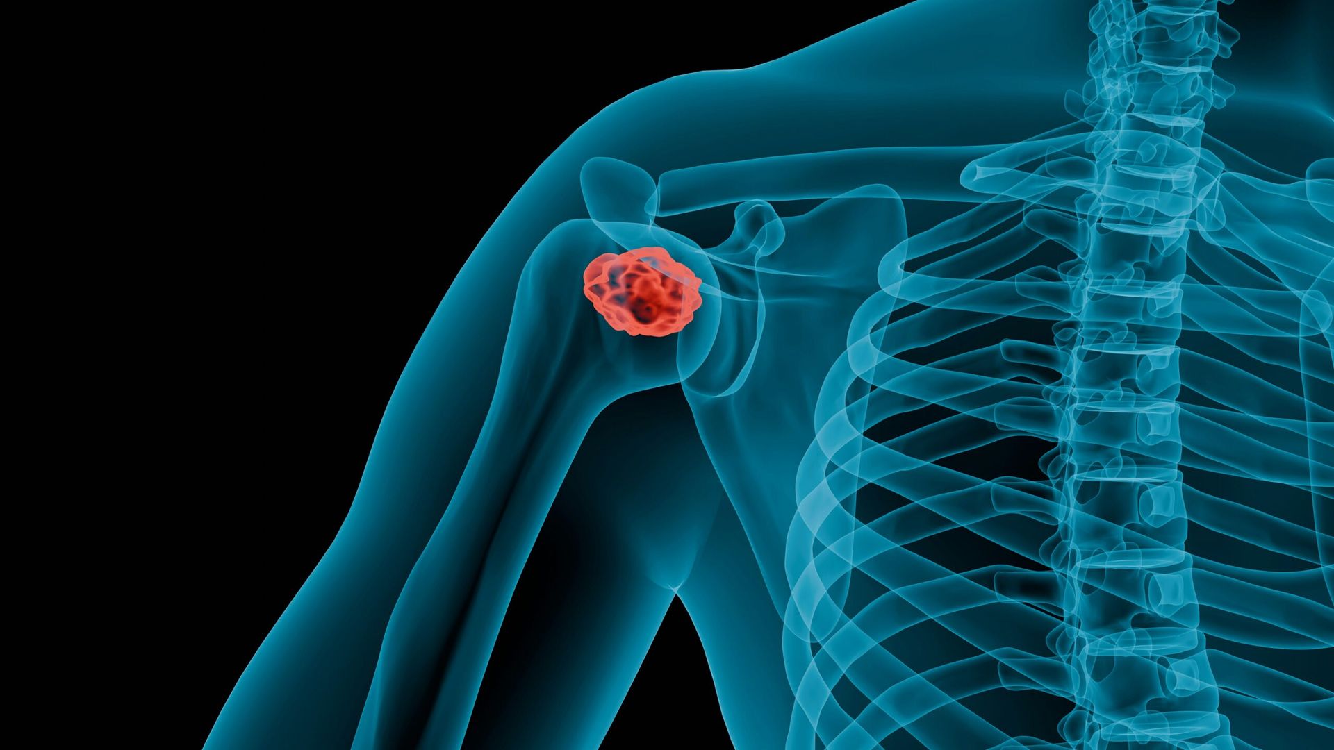 Revolutionizing Prostate Cancer Detection: AI Breakthrough in March 2024