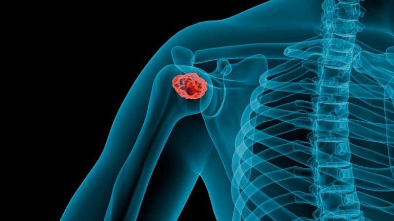 Revolutionizing Prostate Cancer Detection: AI Breakthrough in March 2024