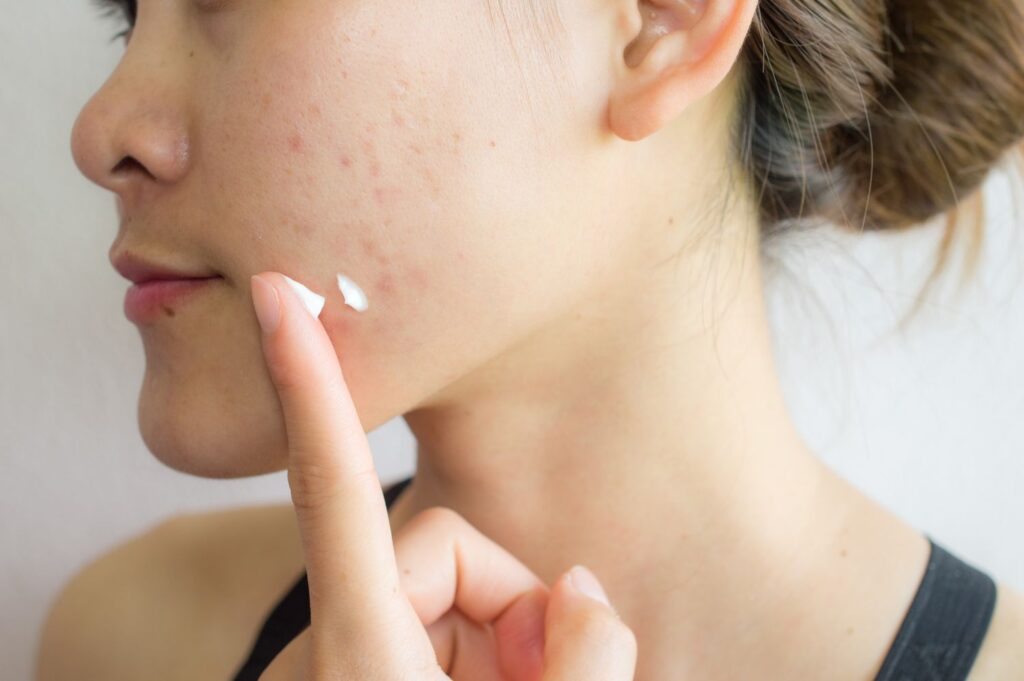 Acne product recall: concern over cancer causing ingredients